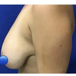 Left-view before photo of breast reduction surgery performed by Dr. David Rankin in Jupiter, FL case 4108.