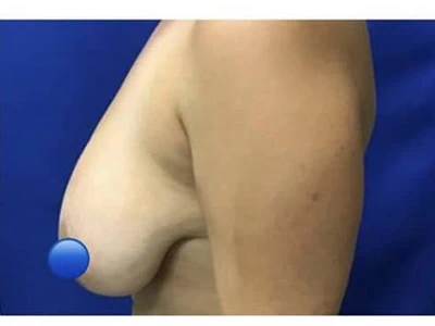 Before - Case #4108: Breast Reduction Surgery