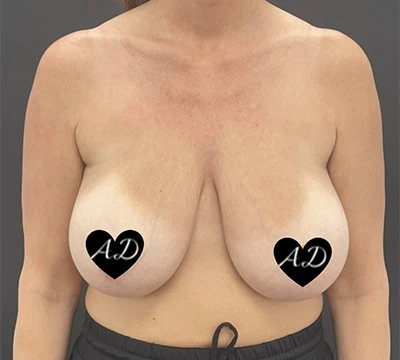Before - Case #3522: Breast Reduction