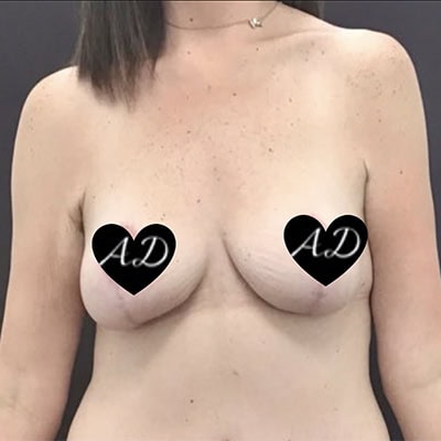 After - Case #3523: Breast Lift