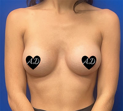 After - Case #3524: Breast Augmentation