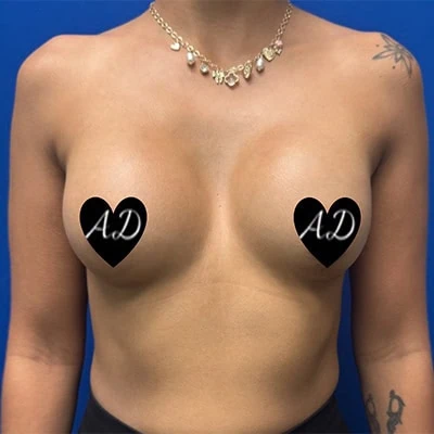 After - Case #3525: Breast Augmentation