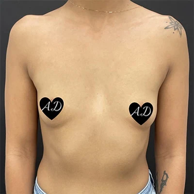 Before - Case #3525: Breast Augmentation