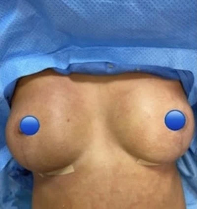 After - Case #4230: Breast Explant with Lift + Fat Transfer