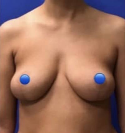 Before - Case #4230: Breast Explant with Lift + Fat Transfer
