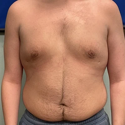 Front-view after photo of gynecomastia surgery performed by Dr. Deziel in Jupiter, FL, case 3514.