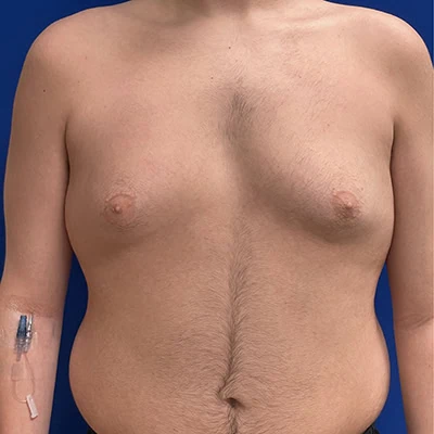 Front-view before photo of gynecomastia surgery performed by Dr. Deziel in Jupiter, FL, case 3514.