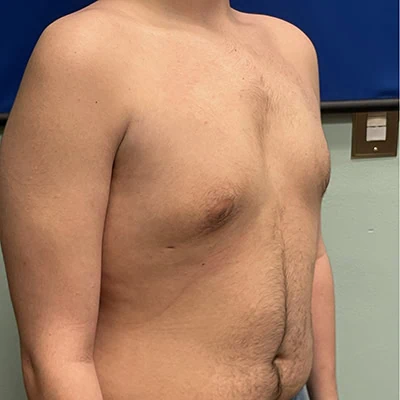 Right-view after photo of gynecomastia surgery performed by Dr. Deziel in Jupiter, FL, case 3514.