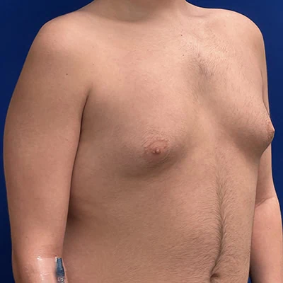 Right-view before photo of gynecomastia surgery performed by Dr. Deziel in Jupiter, FL, case 3514