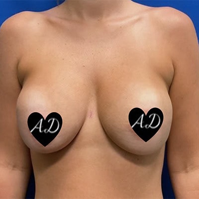 After - Case #3508: Breast Implant Exchange (Upsize)