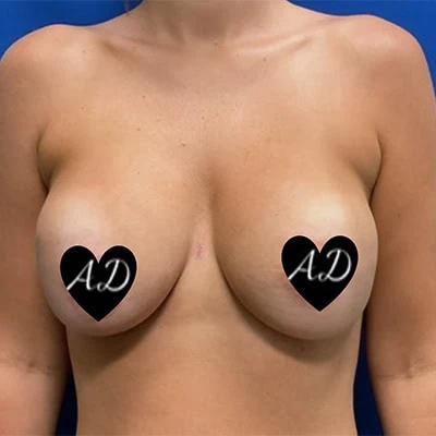 After - Case #3508: Breast Implant Exchange (Upsize)