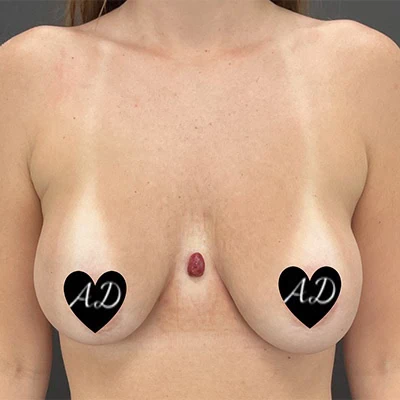 Before - Case #3508: Breast Implant Exchange (Upsize)