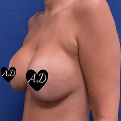 After thumbnail