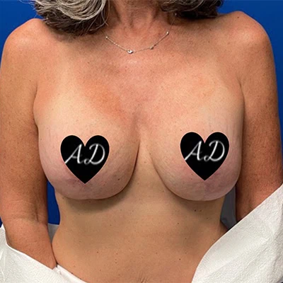 After - Case #3518: Implant Exchange (Upsize) and Lift