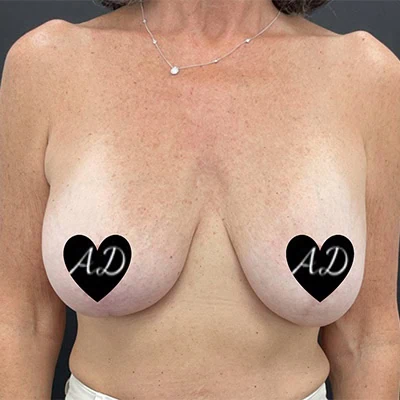 Before - Case #3518: Implant Exchange (Upsize) and Lift