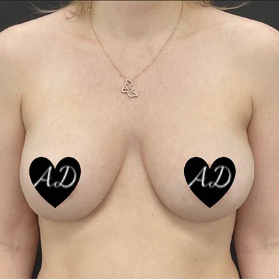 Before - Case #3519: Implant Exchange (Upsize)