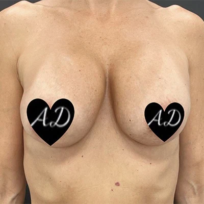 Before - Case #3507: Implant Exchange (Upsize) and Lift