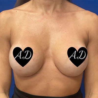 After - Case #3509: Breast Implant Exchange (Upsize)