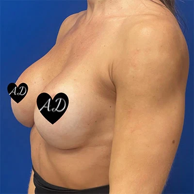 Left-view after photo of breast augmentation surgery performed by Dr. Deziel in Jupiter, FL, case 3509.