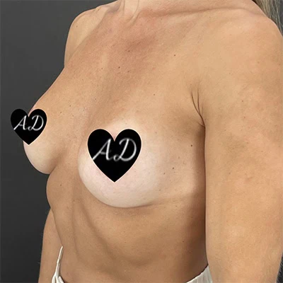 Left-view before photo of breast augmentation surgery performed by Dr. Deziel in Jupiter, FL, case 3509.