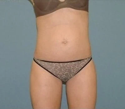 After - Case #4240: Liposuction