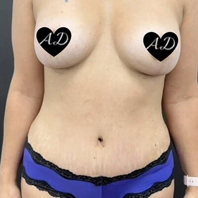 Front-view after photo of mommy makeover surgery performed by Dr. Deziel in Jupiter, FL, case 3517.