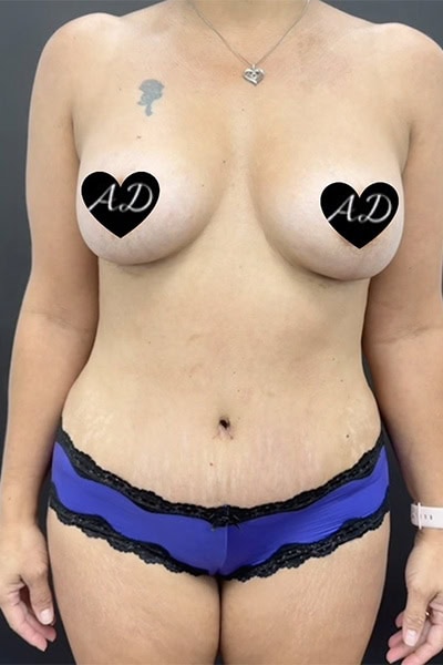 After - Case #3517: Mommy Makeover