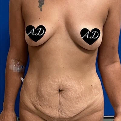 Front-view before photo of mommy makeover surgery performed by Dr. Deziel in Jupiter, FL, case 3517.