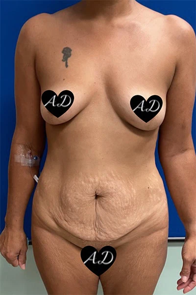 Before - Case #3517: Mommy Makeover