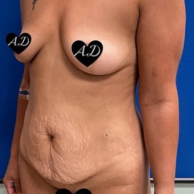 Left-view before photo of mommy makeover surgery performed by Dr. Deziel in Jupiter, FL, case 3517.