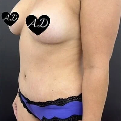 Left view after photo of mommy makeover surgery performed by Dr. Deziel in Jupiter, FL, case 3517.