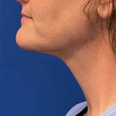 After - Case #3511: Neck Lift