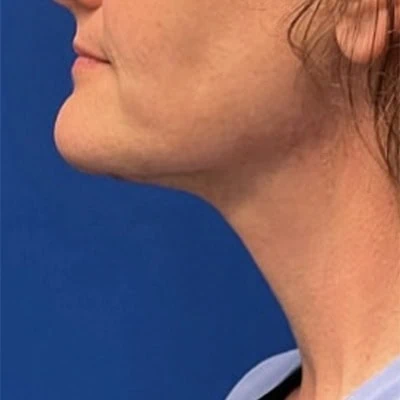 After - Case #3511: Neck Lift