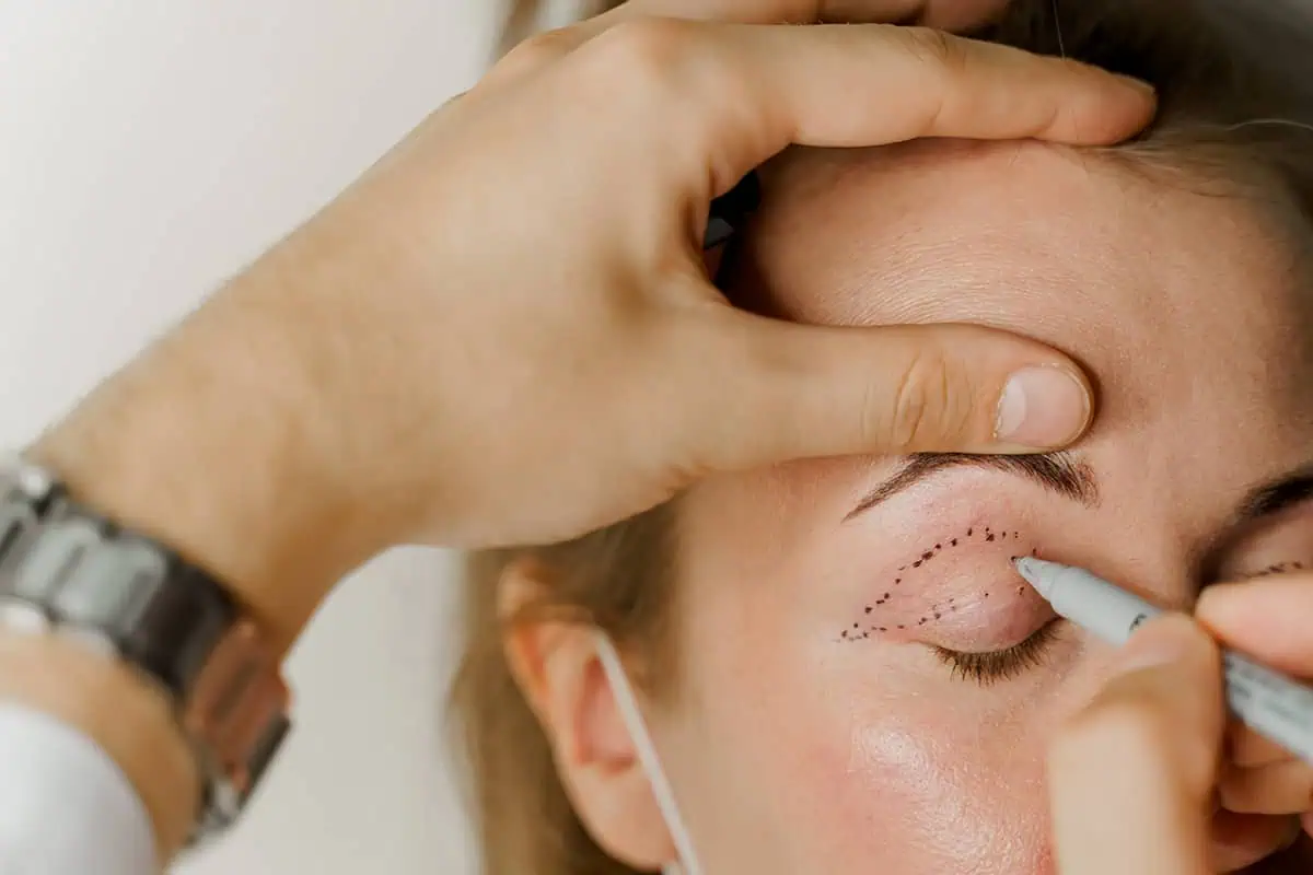 Doctor marking a woman's eye for surgery
