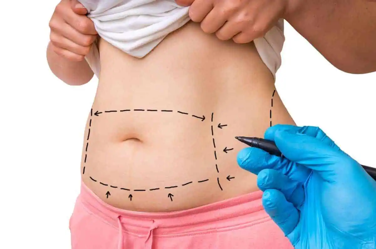 A picture of a woman with her stomach exposed and a doctor marking where the tummy tuck will take place.