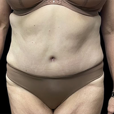 Front-view after photo of tummy tuck surgery performed by Dr. Deziel in Jupiter, FL, case 3501.