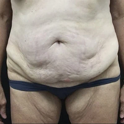 Before - Case #3501: Tummy Tuck