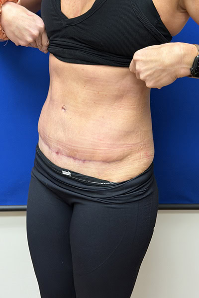 After - Case #3512: Tummy Tuck