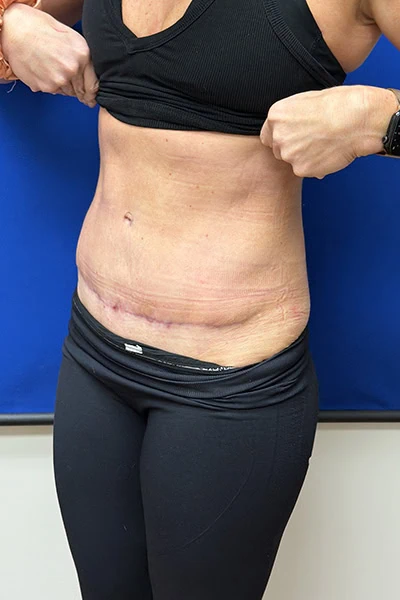 After - Case #3512: Tummy Tuck