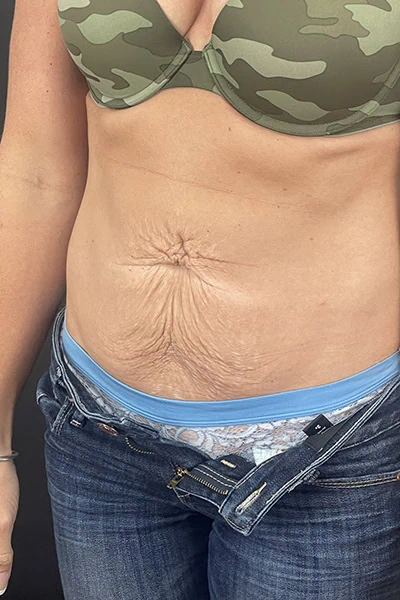 Before - Case #3512: Tummy Tuck