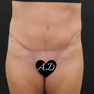 After - Case #3513: Tummy Tuck