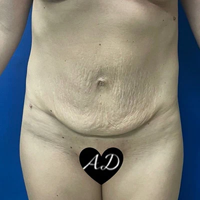 Before - Case #3513: Tummy Tuck