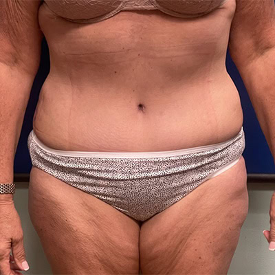 After - Case #3505: Tummy Tuck