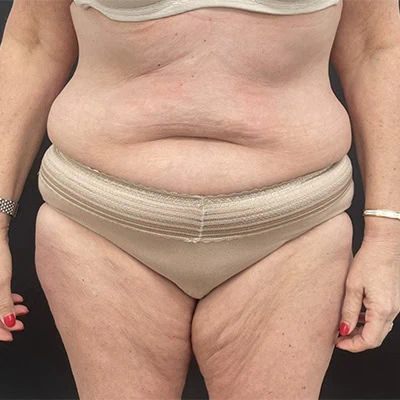 Before - Case #3505: Tummy Tuck