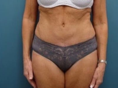 After - Case #4243: Tummy Tuck