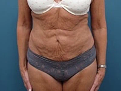 Before - Case #4243: Tummy Tuck