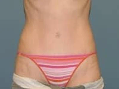 After - Case #4246: Tummy Tuck