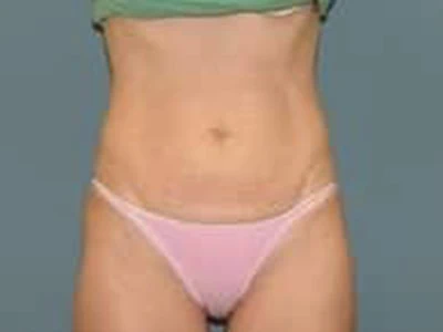 Before - Case #4246: Tummy Tuck