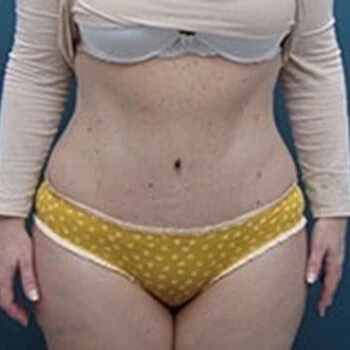 Front-view after photo of tummy tuck surgery performed by Dr. David Rankin in Jupiter, FL, case 4249.
