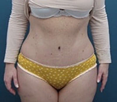 After - Case 4249: Tummy Tuck and Liposuction (Hips)